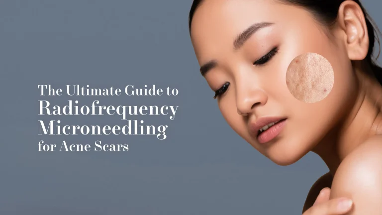 The Ultimate Guide to Radiofrequency Microneedling for Acne Scars | Mizu